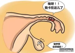 输卵管妊娠的自我检查、症状及治疗方法 输卵管妊娠的自我检查、症状及治疗方法