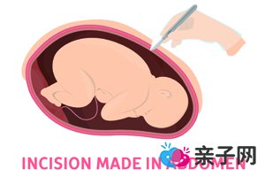 第三产程延长